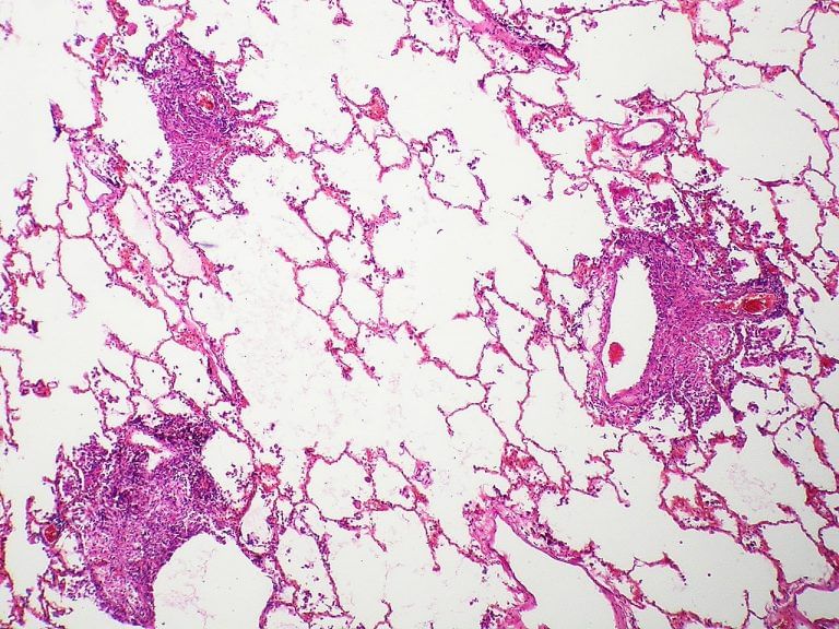 Tuberculosis kills 4000 people everyday : Understanding the world’s problem with the deadly disease