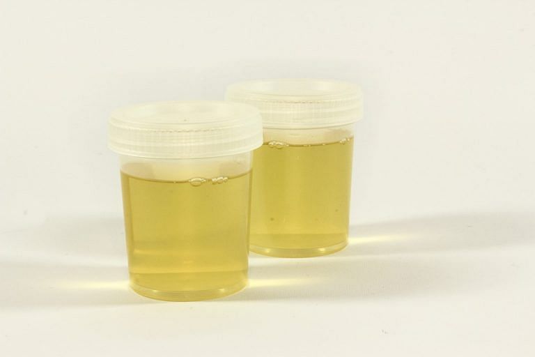 Your urine may have clues that can help detect cancer before it strikes