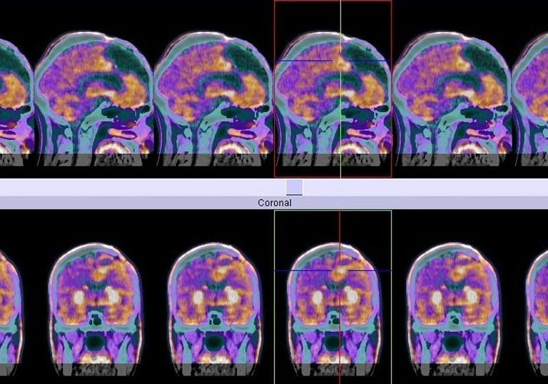 Brain cancer: Why killing the fastest growing cells may not be the only treatment