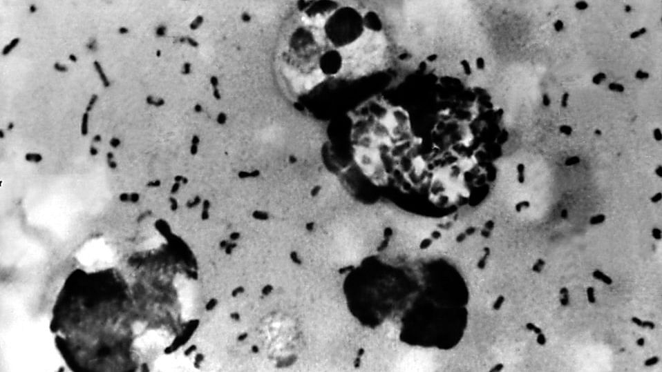 Bubonic Plague smear demonstrating the presence of Yersinia pestis bacteria.