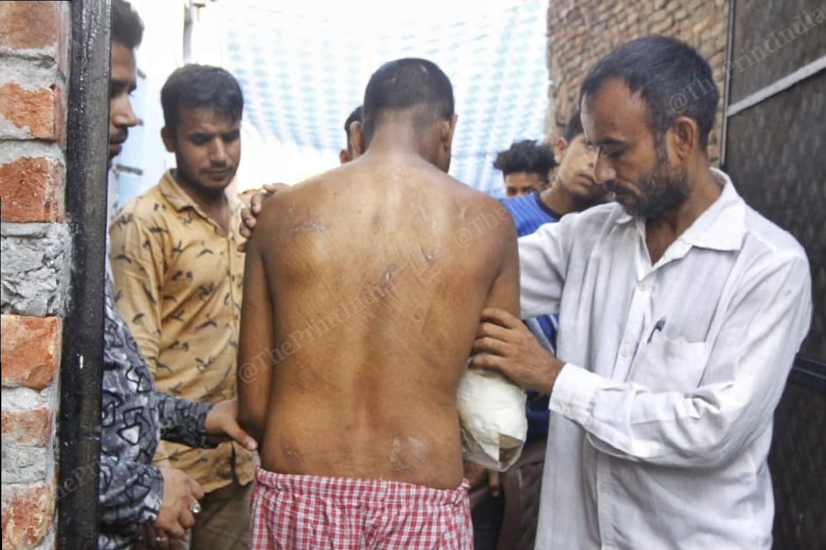 Ikhlaq showing his back injuries | Praveen Jain | ThePrint