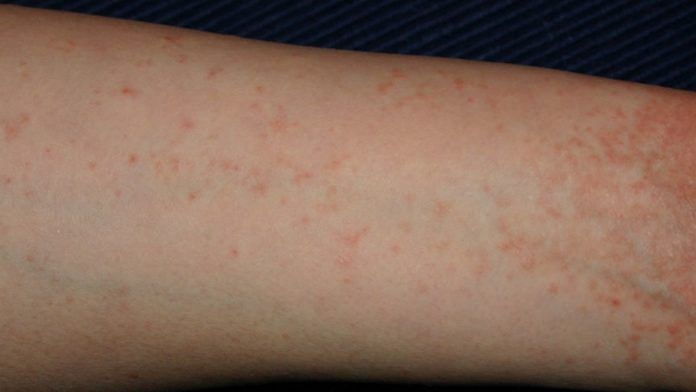 Early signs of Scabies | The Pediatric Center