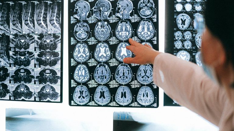 More accurate way to predict who will develop Alzheimer’s disease – new study