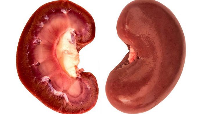 Kidneys | Representational image | Commons