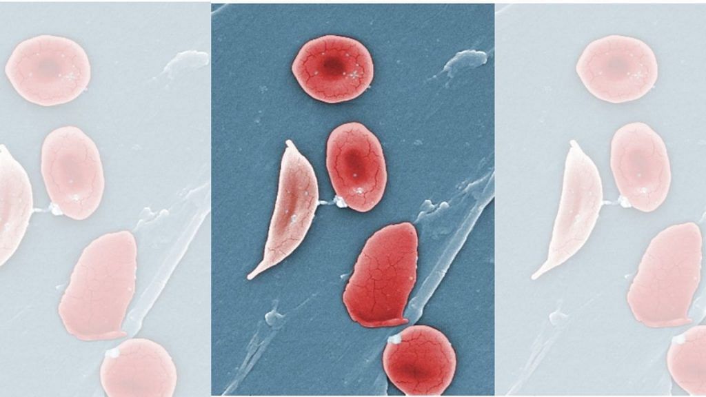 Representational image of a sickle blood cell beside normal red blood cells | Wikipedia