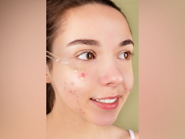 Fat cells in skin help fight acne: Study