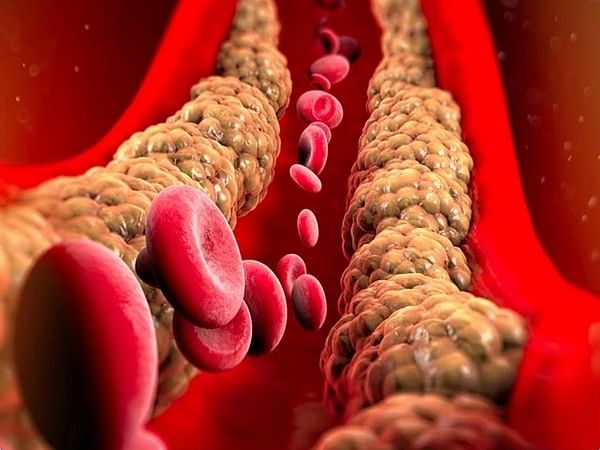 High triglycerides may increase risk of second stroke, suggests study
