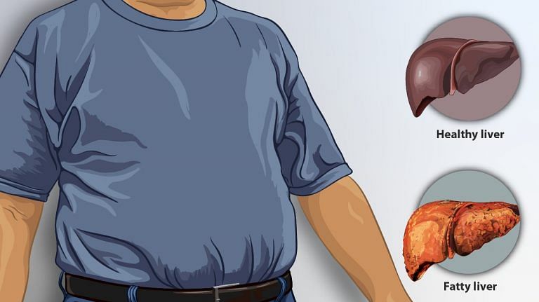 Here are the genetic factors for a fatty liver and why you should be worried