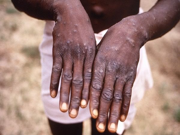 France reports first case of monkeypox