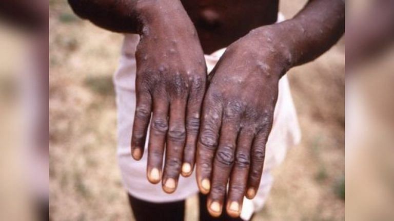 Cases of Monkeypox confirmed in UK and US: Experts discuss if it is a cause for concern