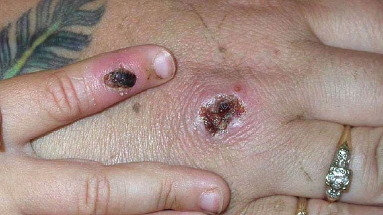 Monkeypox doesn’t pose Covid-sized threat, no reason to panic