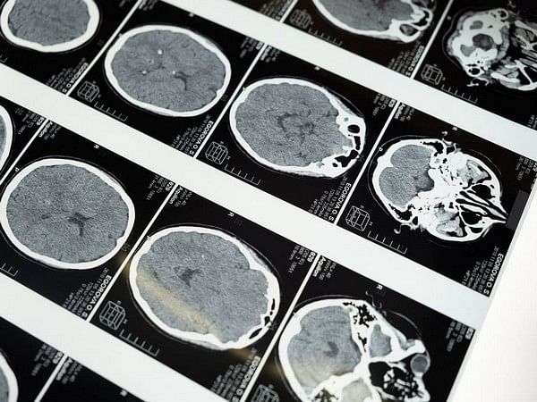 Researchers find new approach for treatment of devastating brain tumours