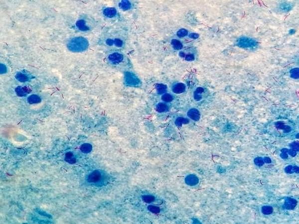 In the largest series of phage therapy case studies, more than half of the patient's rate was successful: Study