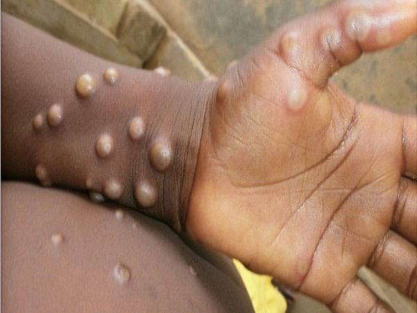 Five-year-old girl in UP's Ghaziabad with suspected Monkeypox infection tests negative 