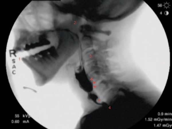 Research shows new guidelines set to standardize swallowing fluoroscopy