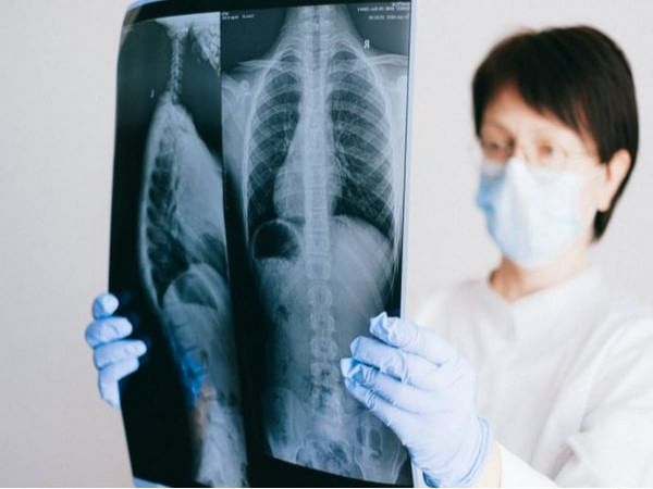 Study suggests new biomarker speeds identification of lung disease