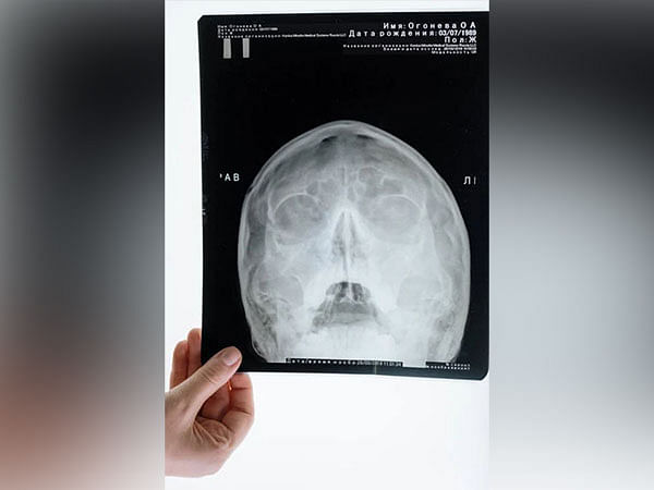 Surgery can be avoided for children with rare skull tumor: Study