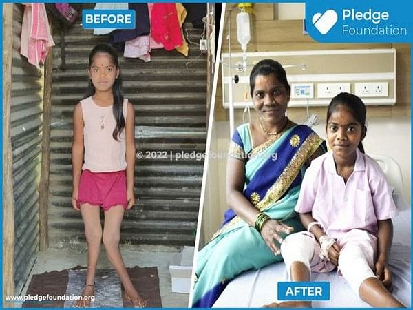 Pledge Foundation's Emergency Medical Care Project saved life of 12-year-old Rupali