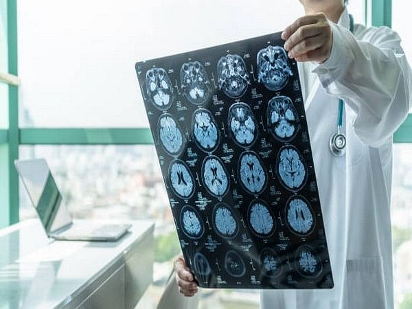 Study reveals Alzheimer's may lead to loss of visual memory