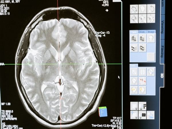 Alzheimer's degrades cells that cross hemispheres, visual memory suffers: Study