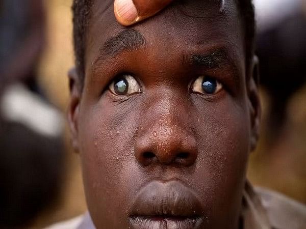 Researchers discover new diagnostic method for posterior uveitis eye disease