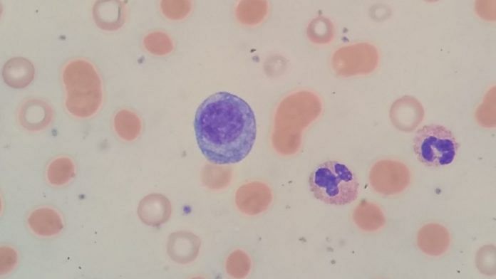 Peripheral blood smear showing findings associated with multiple myeloma | Representational image | Commons