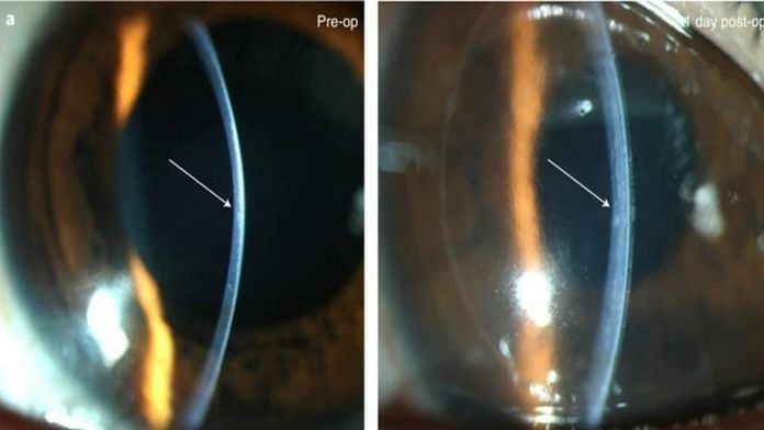Slit-lamp photographs pre-operative (left) and one day post-operative (right) indicate immediate change in thickness and curvature in the central cornea | Images sourced from study published in Nature Biotechnology