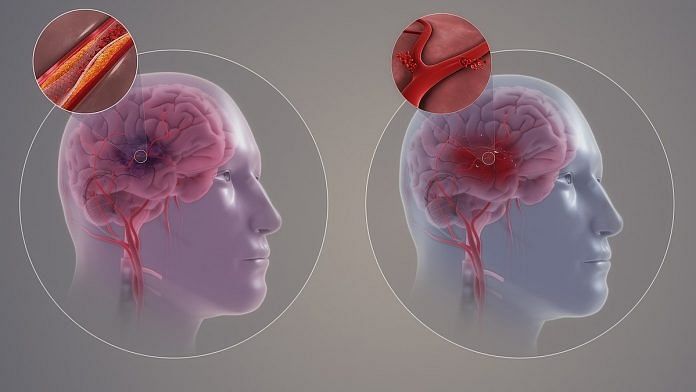 A graphical representation of ischemic stroke and haemorrhagic stroke | Commons