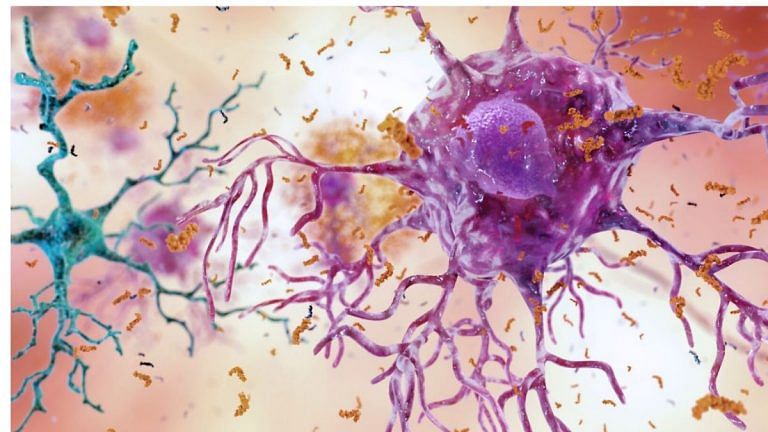 A new theory suggests Alzheimer’s is an autoimmune condition