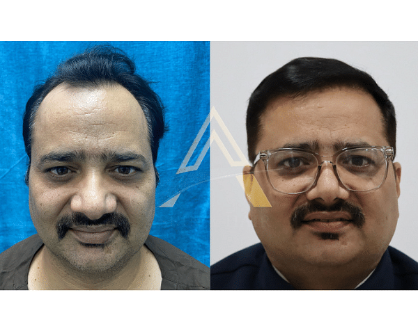 Dr Alok Sahoo, MD (AIIMS) to launch a new hair transplant clinic in  Bhubaneswar – ThePrint – ANIPressReleases