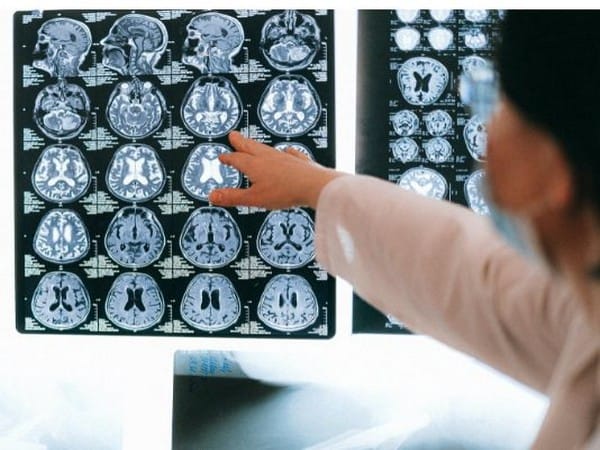 Transcranial magnetic stimulation shows potential to treat psychiatric diseases: Research 