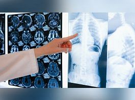 Hospitalization during COVID-19 damages lungs: Study
