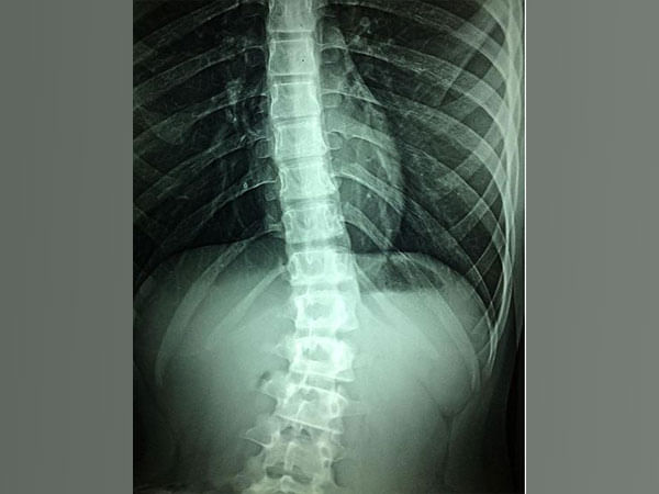 Researchers suggest new way of treating spinal cord injury