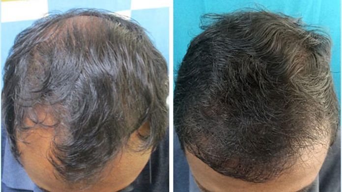 VCare's Hair Transplantation Ensures To Completely Reverse Baldness