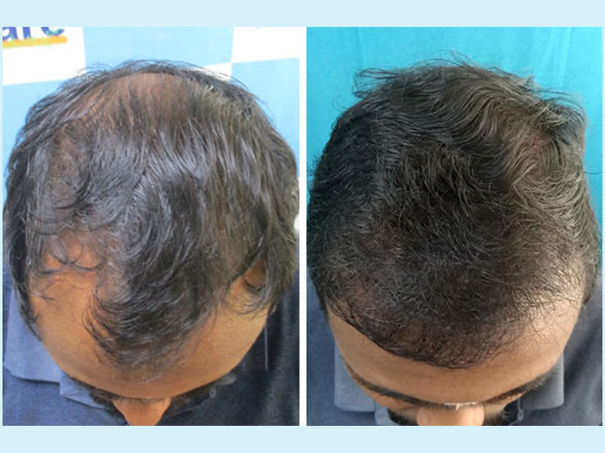 VCare's Hair Transplantation Ensures To Completely Reverse Baldness –  ThePrint – ANIPressReleases
