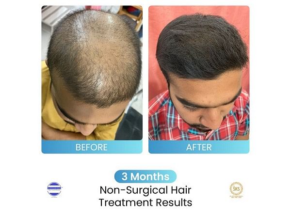 Dr Stuti Khare Shukla's Non-Surgical Hair Growth Booster helping multiple people suffering from Hair Loss Issues – ThePrint – ANIPressReleases Dr Stuti Khare Shukla's Non-Surgical Hair Growth Booster helping multiple people suffering from Hair Loss Issues – ThePrint – ANIPressReleases