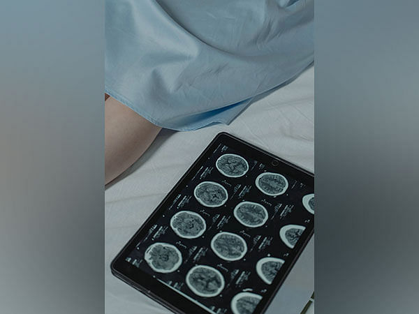 Study shows machine learning can predict development of brain tumours
