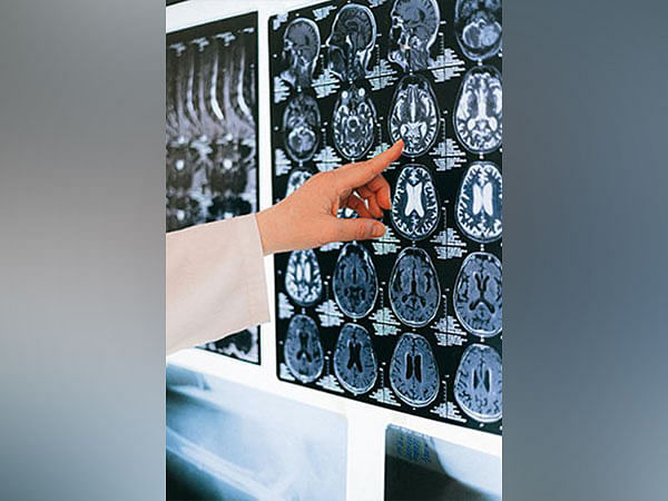 Study reveals how CBD counters epileptic seizures