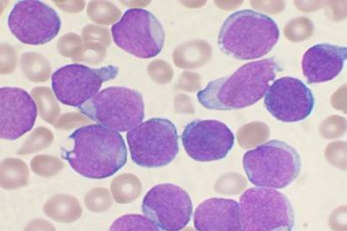 A Wright's stained bone marrow aspirate smear from a patient with B-cell acute lymphoblastic leukemia | Commons