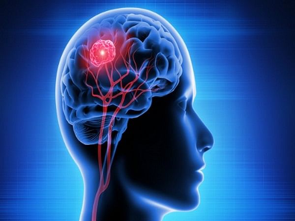 Study finds memory, mental health of people with epilepsy linked with neighborhood