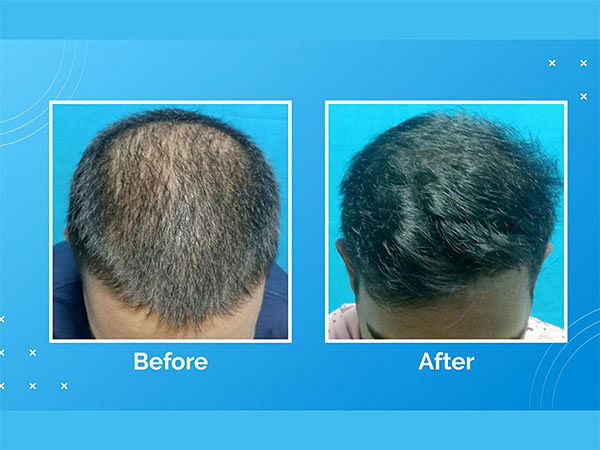 VCare's treatment for hair loss and hair thinning – ThePrint 