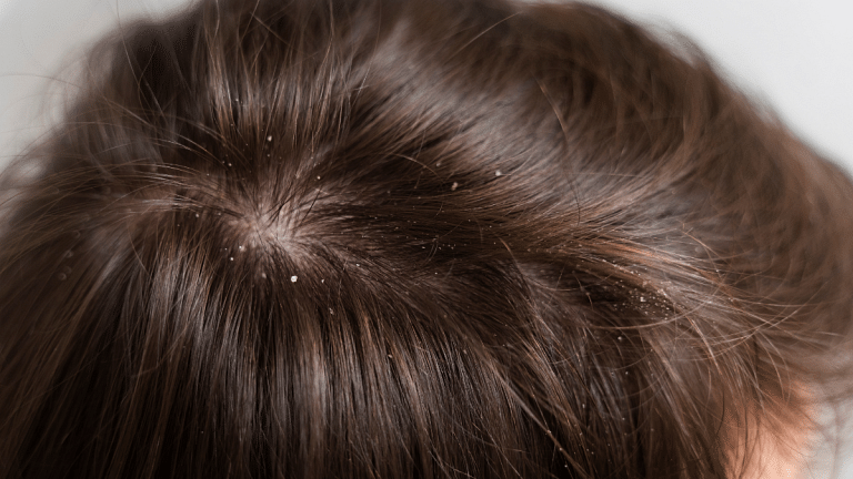 Washing your hair less or using too many products can worsen dandruff. Do this instead