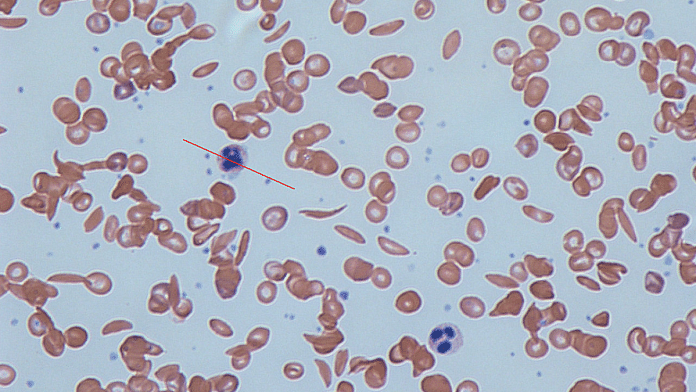 Representational photo of Sickle Cell Disease | Commons