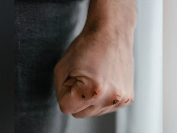 Researchers develop new hydrogels for wound management