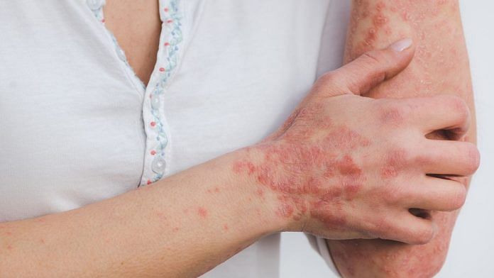Psoriasis rash | @Miller_Ezster | Pixabay