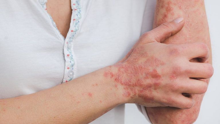 Don’t treat psoriasis as a cosmetic condition – it’s more than a pesky skin rash