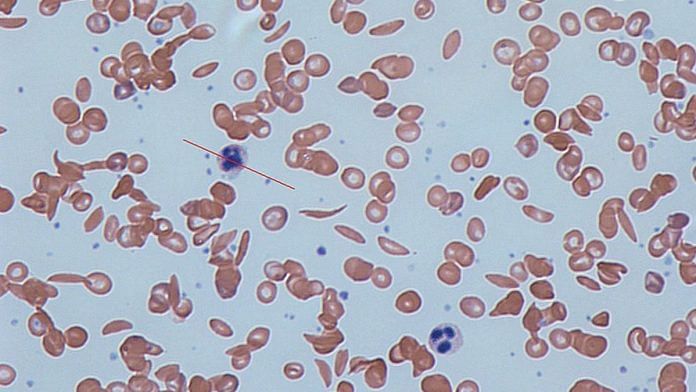 Representational photo of Sickle Cell Disease | Commons