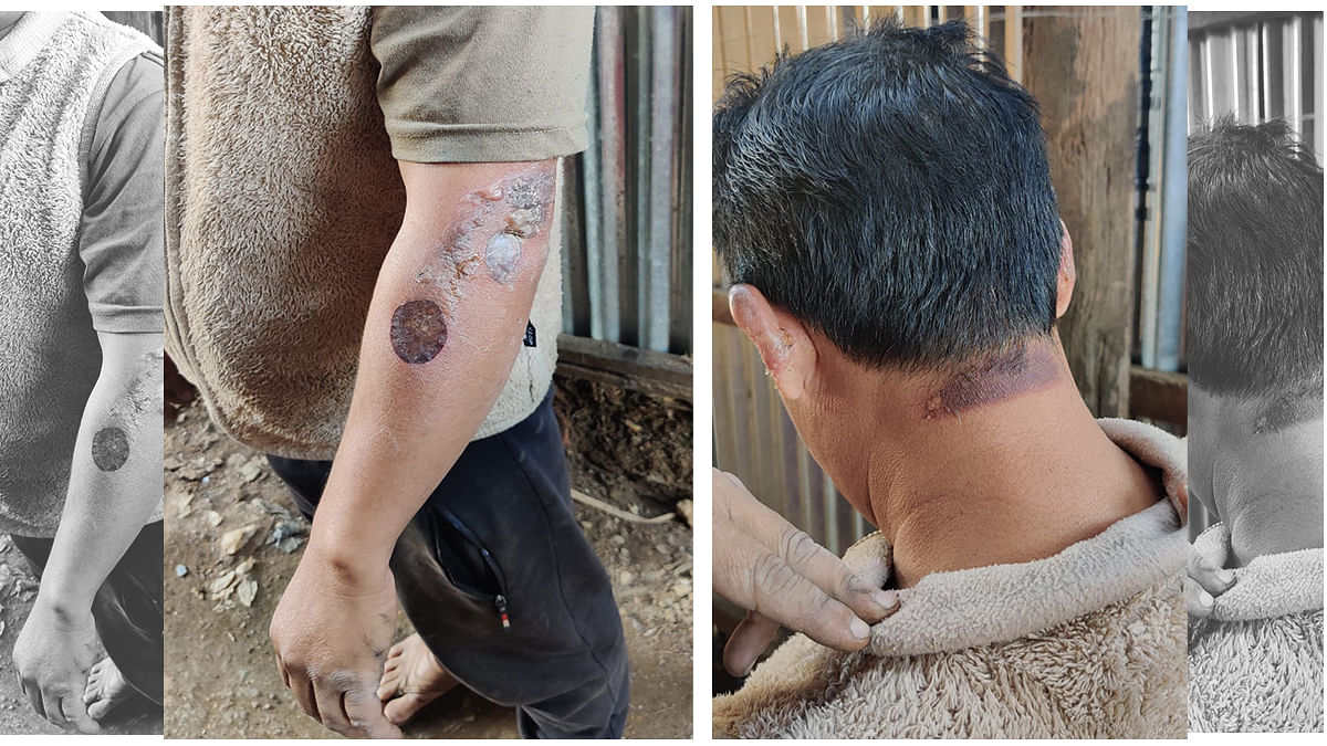 Man of Nepali origin showing his burn injuries | Sourav Roy Barman | ThePrint