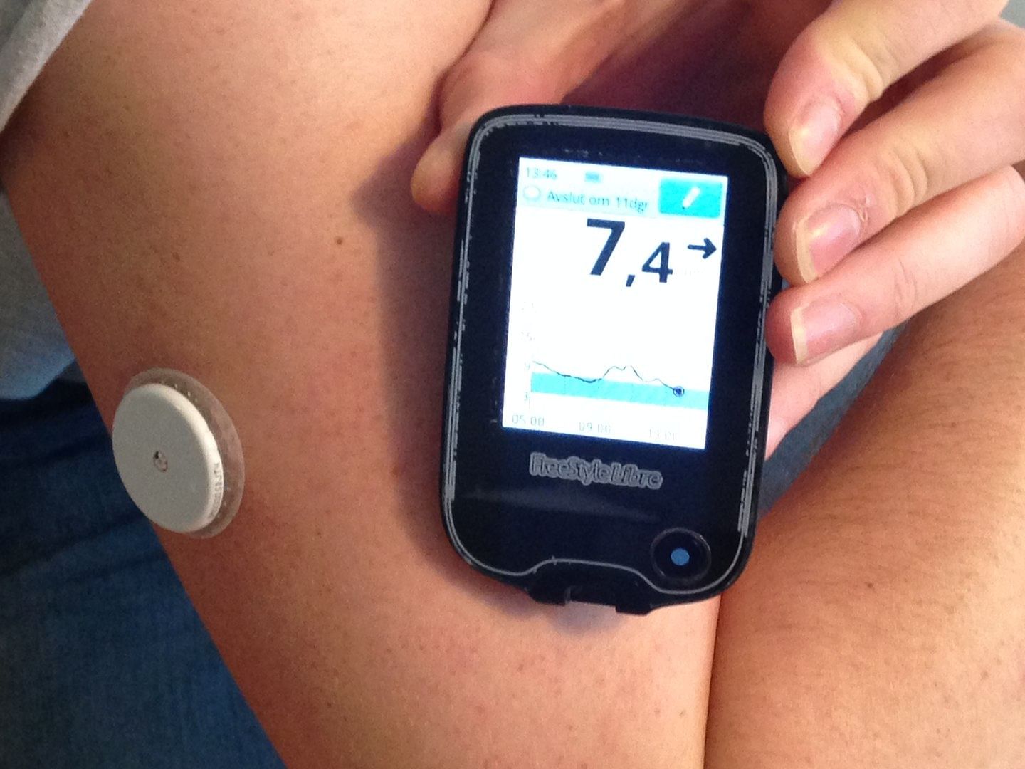 Continuous glucose monitor (CGM) device | Commons 