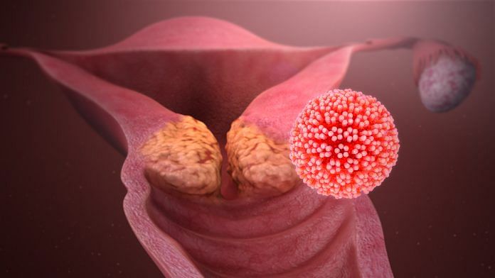 Representational image of HPV | Commons